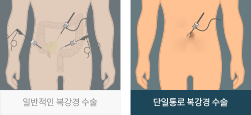 일반적인 복강경 수술 이미지와 단일통로 복강경 수술 이미지